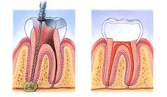 Root Canals