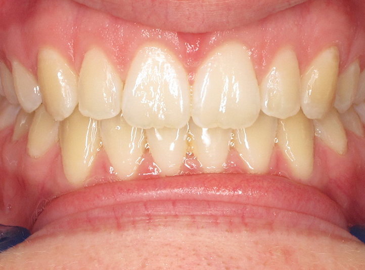 1 after anterior teen