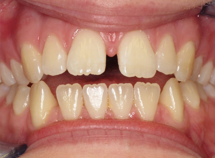 1 before anterior teen 1 before anterior teen