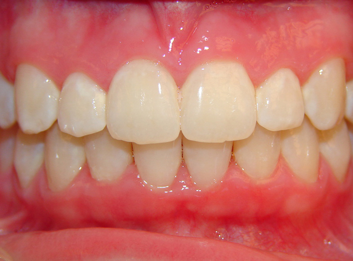 2 after anterior girl