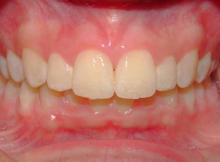 2 before anterior girl 2 before anterior girl