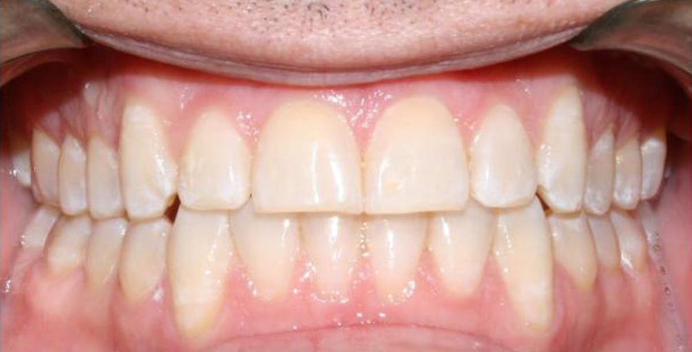 3 after anterior adult