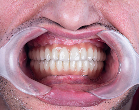 after dental implants