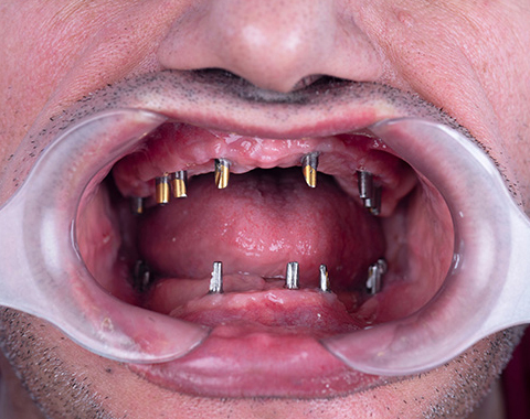 before dental implants