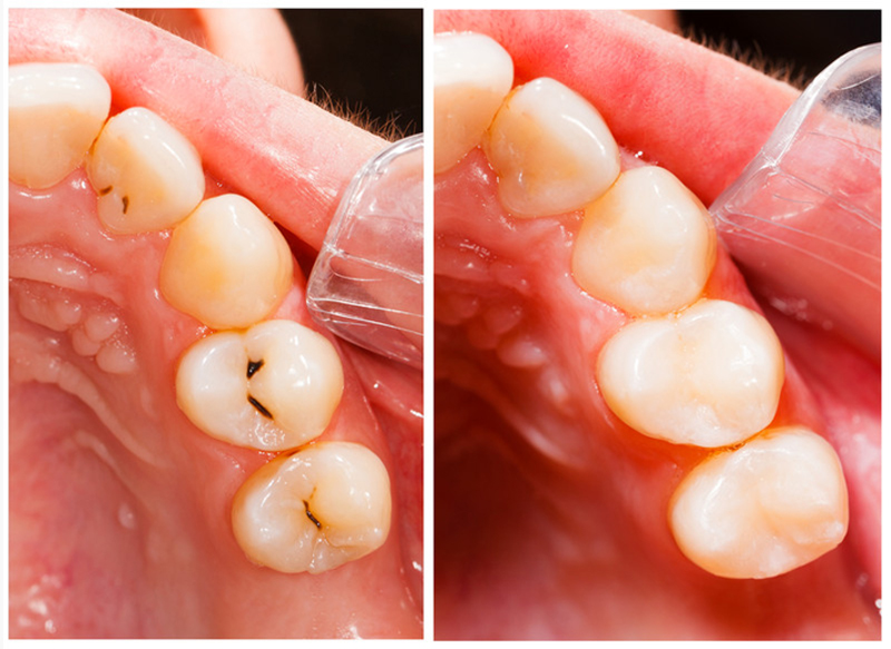 Resin Composite Fillings