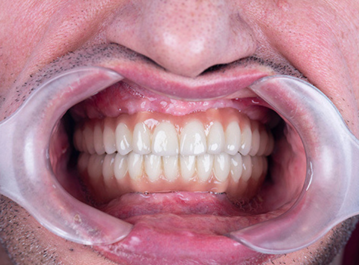 IMPLANT_AFTER_RESIZED